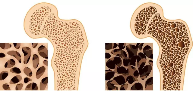 The Link between Amenorrhea and Osteoporosis
